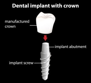 ccid implant diagram 01 300x275