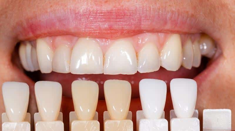 Chicago Residents Improve Their Smiles With Porcelain Veneers 6573788d2b7c5.jpeg