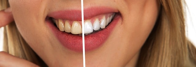 Dangers of “Do It Yourself” Teeth Whitening 65737633dc203.jpeg