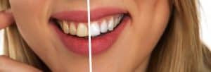 Dangers of “Do-It-Yourself” Teeth Whitening