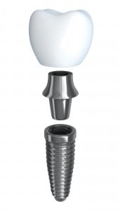 Dental Implants: Counting the Cost of a Healthy Smile 65737725af17d.jpeg