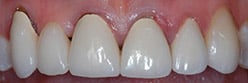 dentists chicago gum therapy before