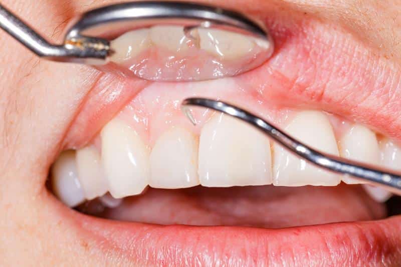 Gum Recession Treatments in Dentistry for Chicago 6573789375939.jpeg