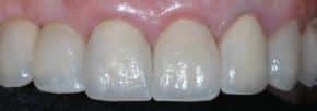 Qualifying for Dental Implants as Schaumburg Residents 6573785d0b0c7.jpeg